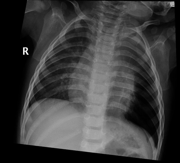 Foreign body inhalation_Table Image 2 Foreign body inhalation_Table Image 2